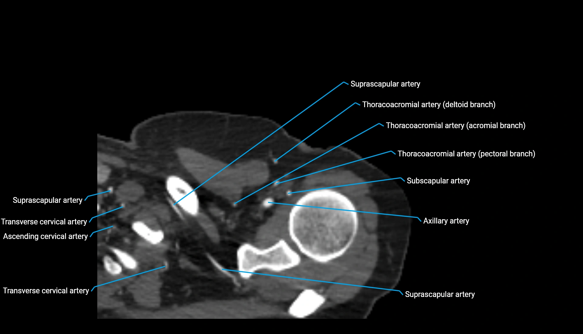CTA upper limb axial cross sectional anatomy labelled image 328 (1).webp
